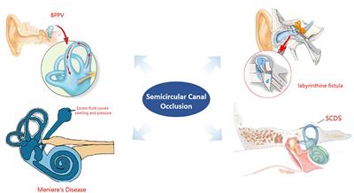 Development of semicircular canal occlusion